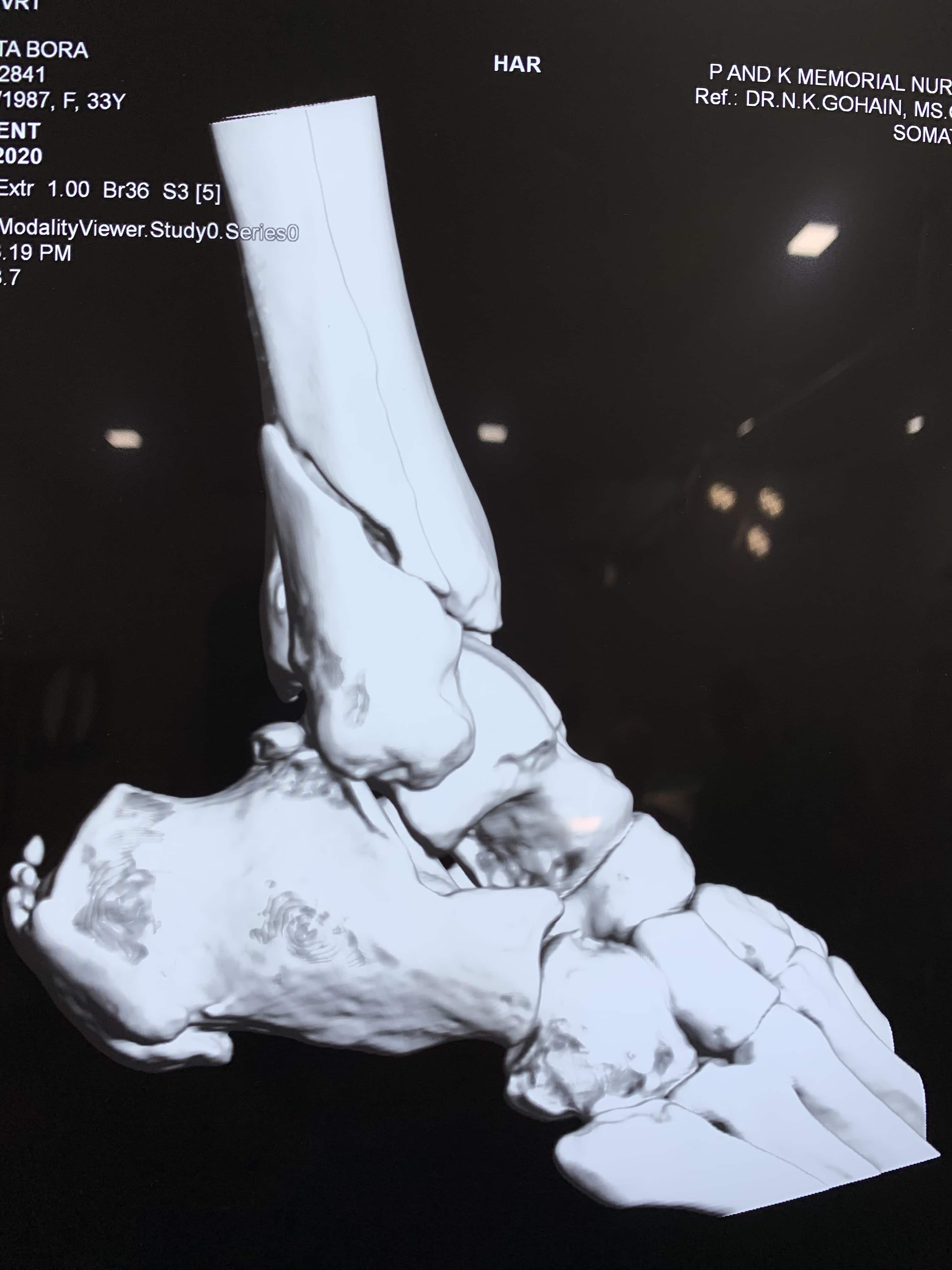 Complex Distal Humerus Comminuted Fracture