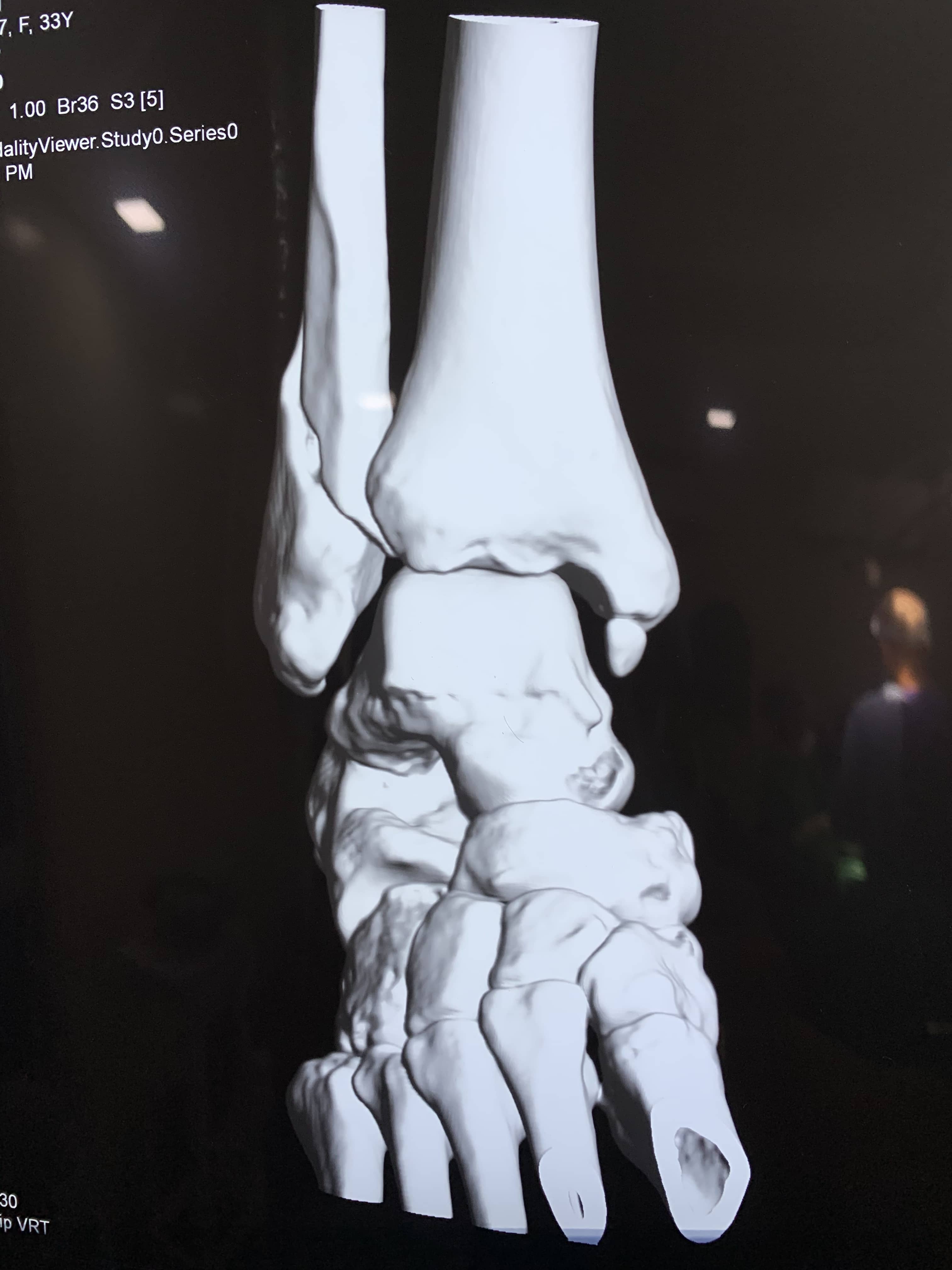 Ankle Sprain With Pott’s Fracture