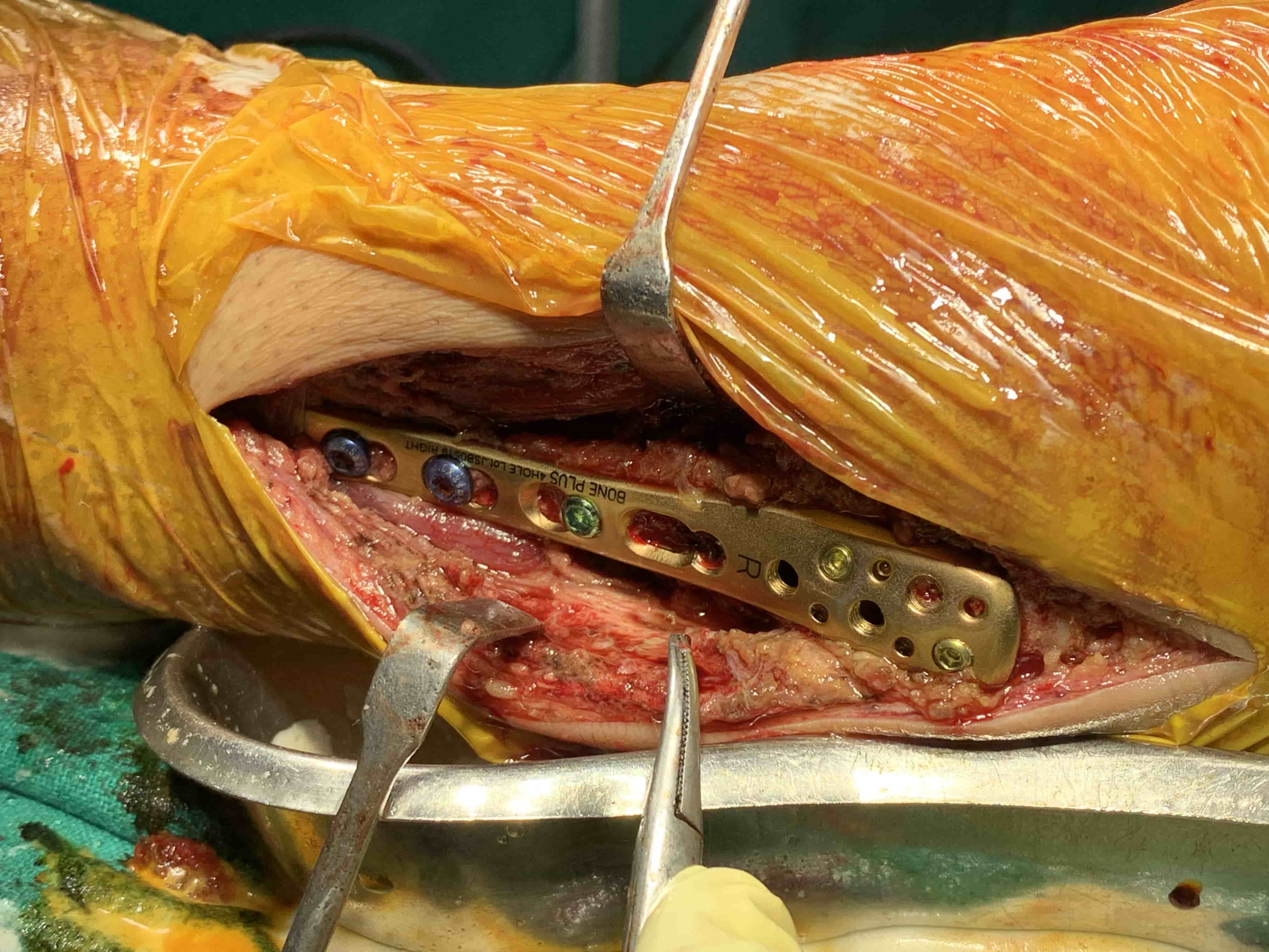 Ankle Sprain With Pott’s Fracture