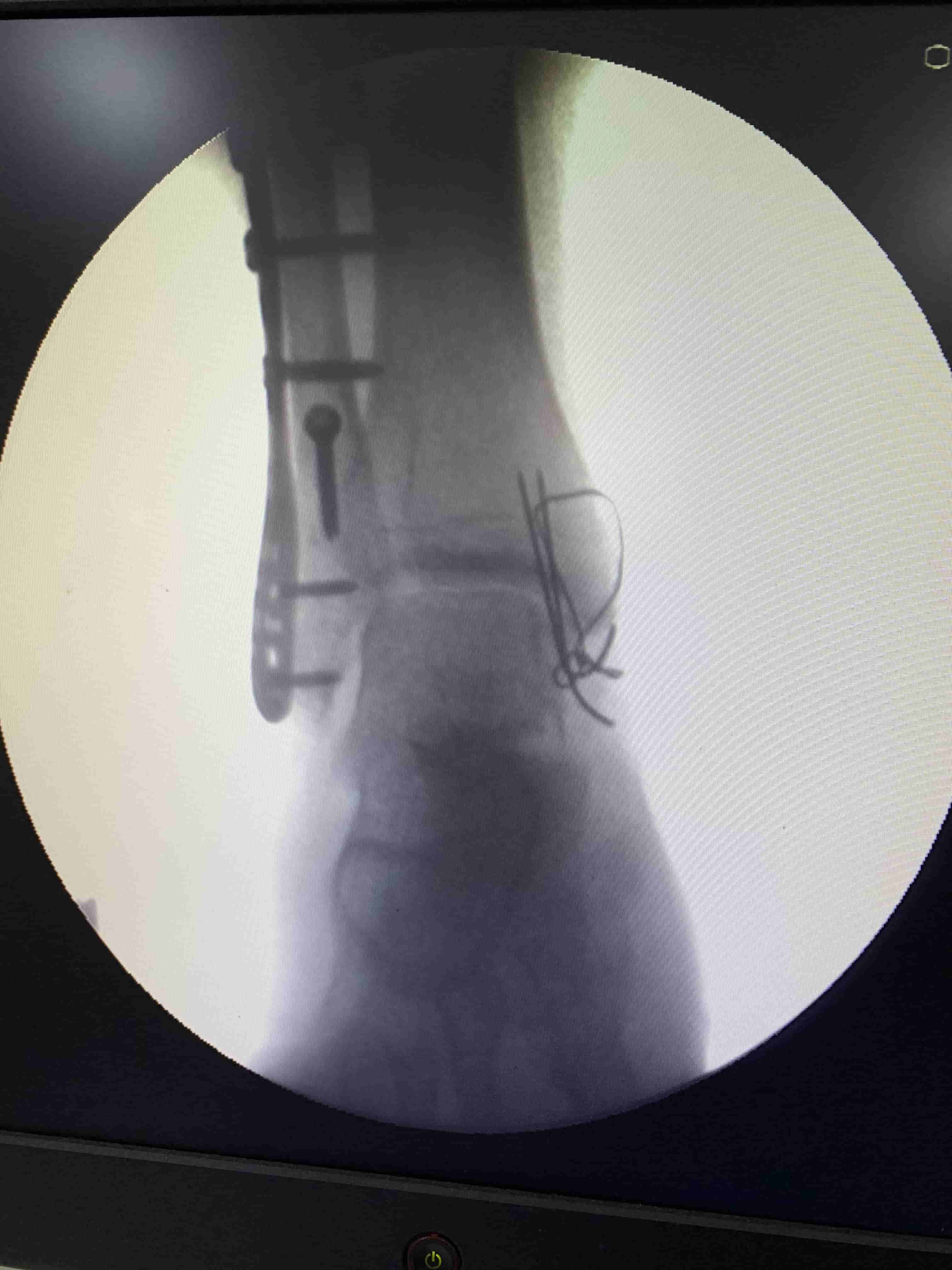 Ankle Sprain With Pott’s Fracture