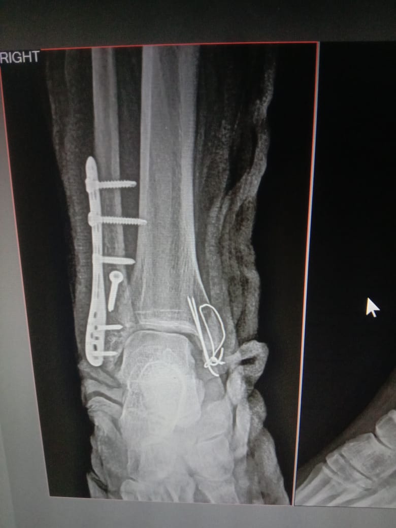Ankle Sprain With Pott’s Fracture
