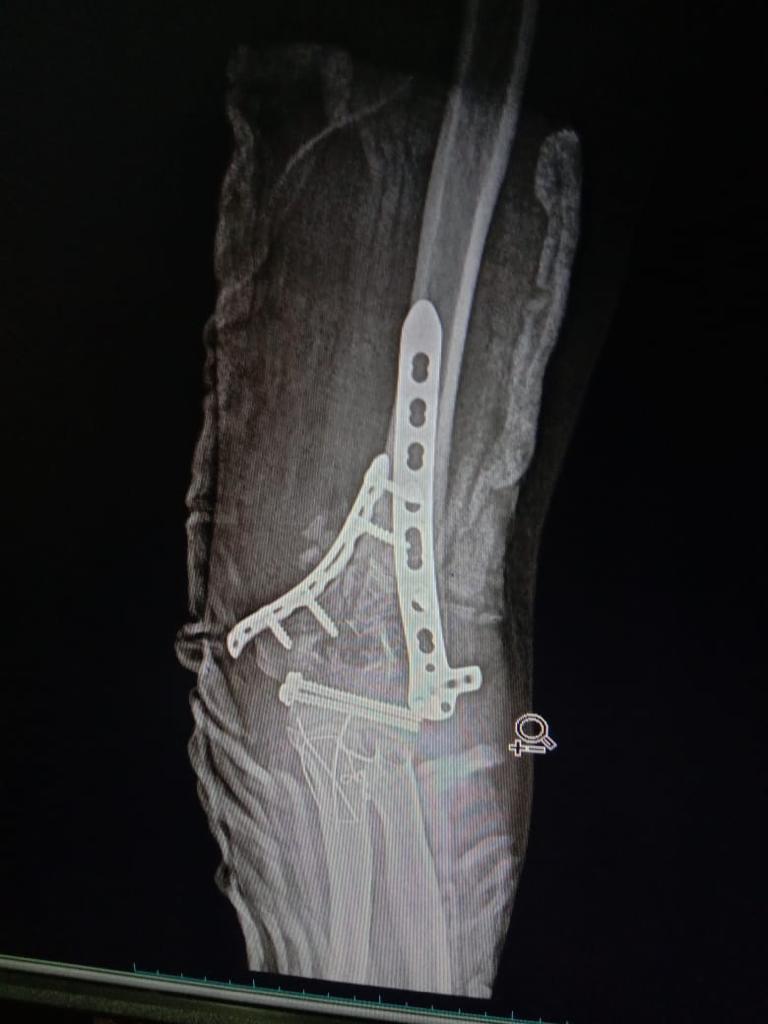 Complex Distal Humerus Comminuted Fracture