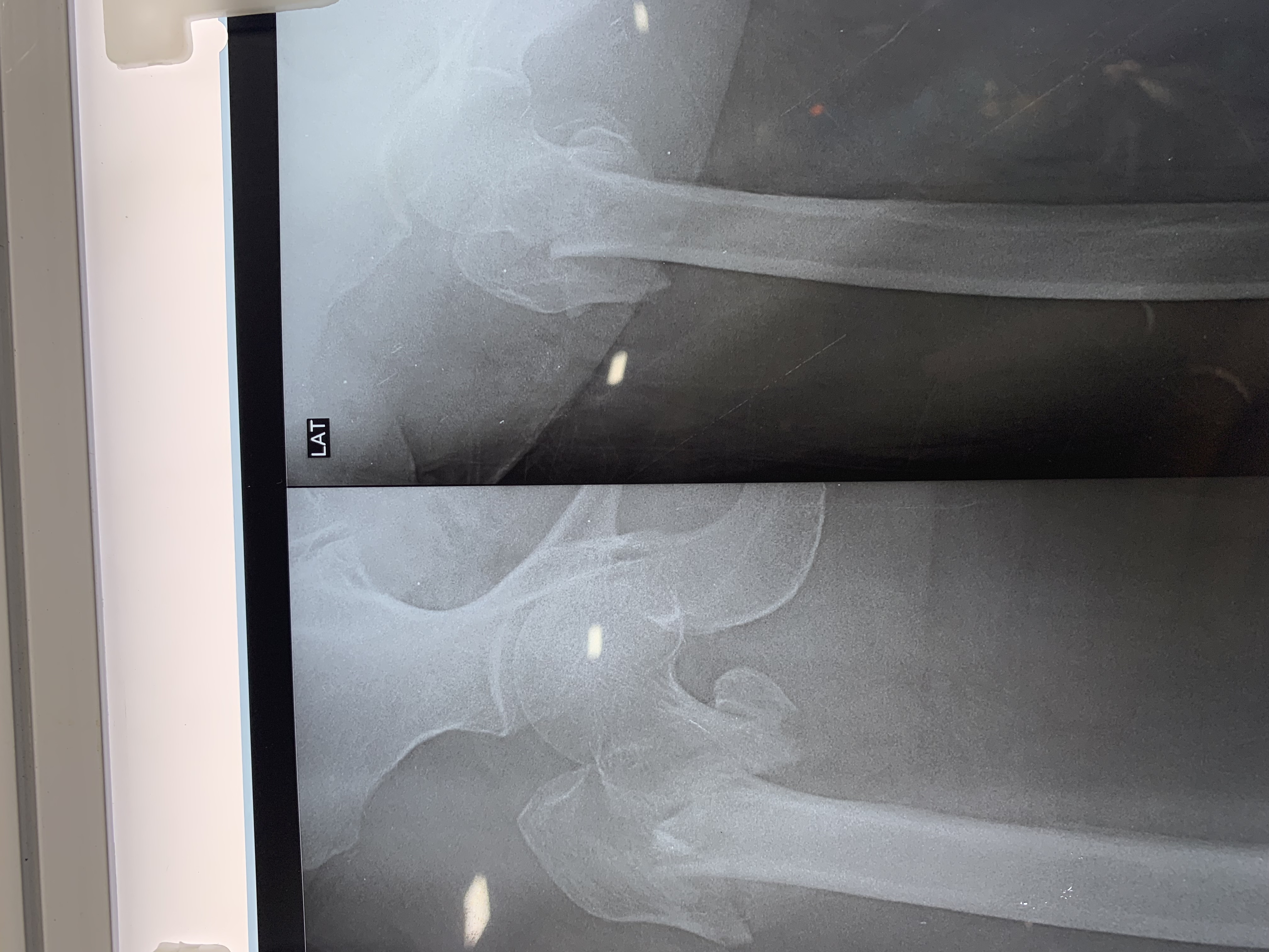 Intertrochanteric femur comminuted fracture treated by Closed Reduction & Internal Fixation with PFNA2 Titanium Interlocking Nail