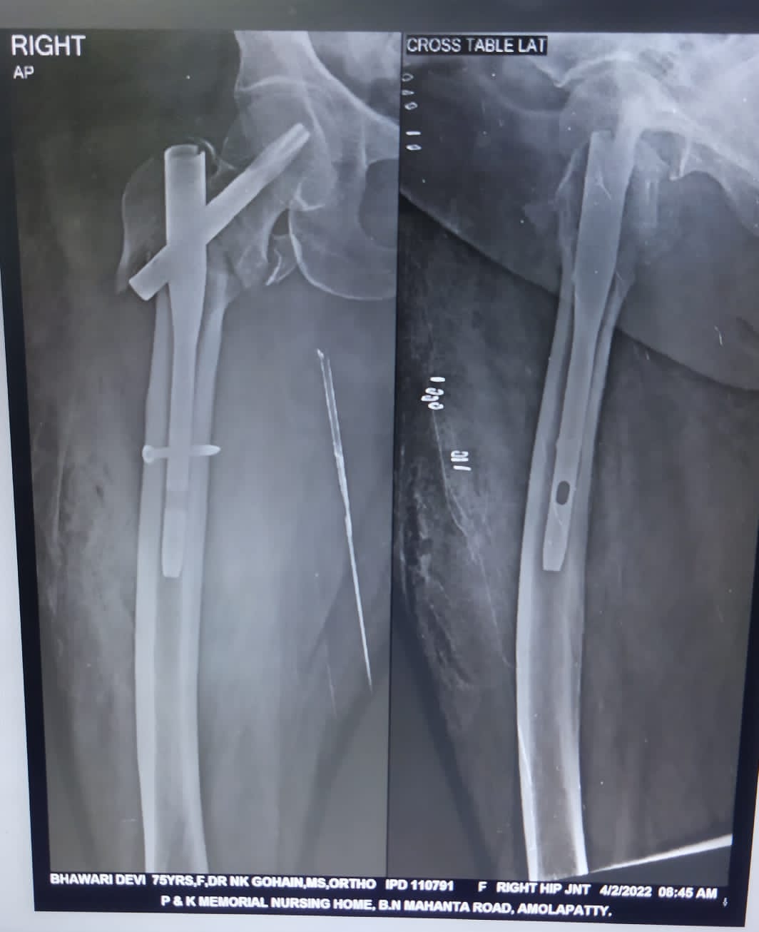 Intertrochanteric femur comminuted fracture treated by Closed Reduction & Internal Fixation with PFNA2 Titanium Interlocking Nail