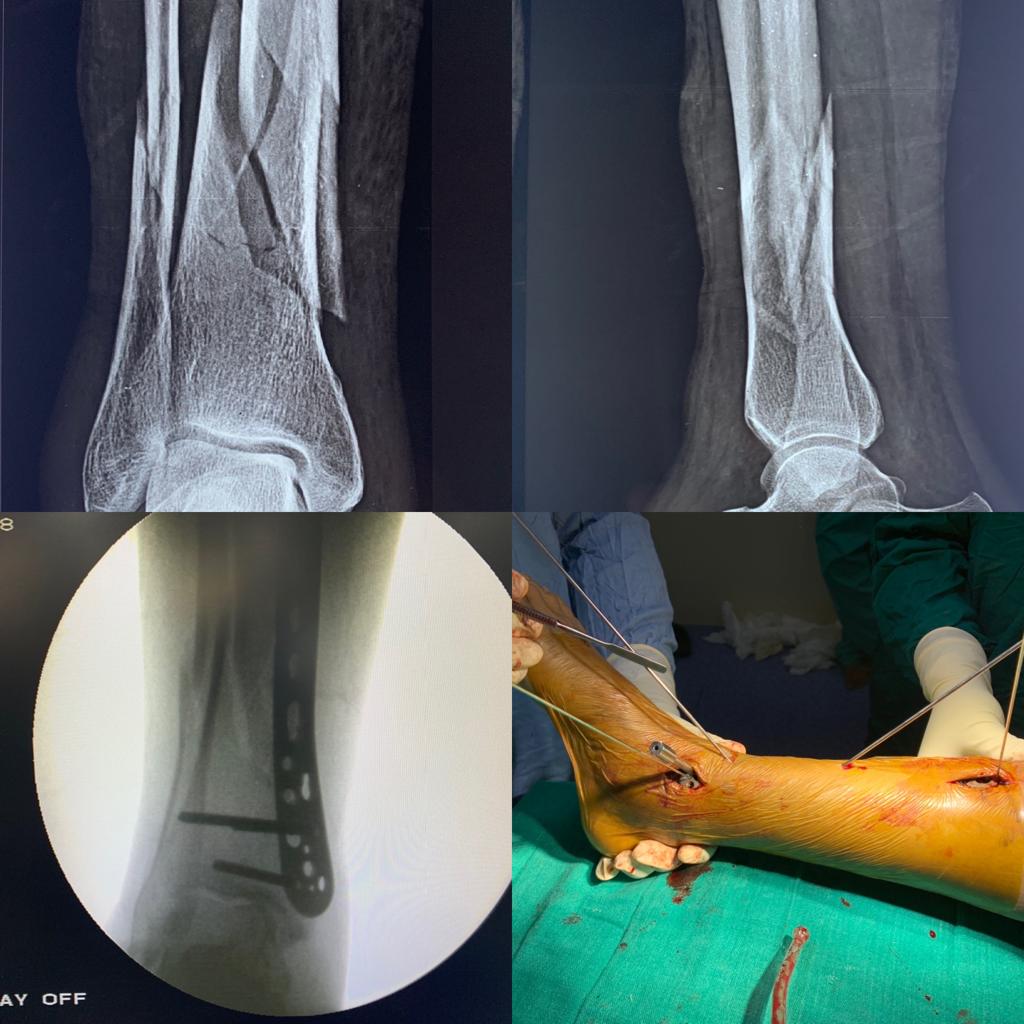 MIPPO in a distal one third tibia-fibula comminuted fracture in a patient of rheumatoid arthritis with osteoporosis with anaemia of chronic disease