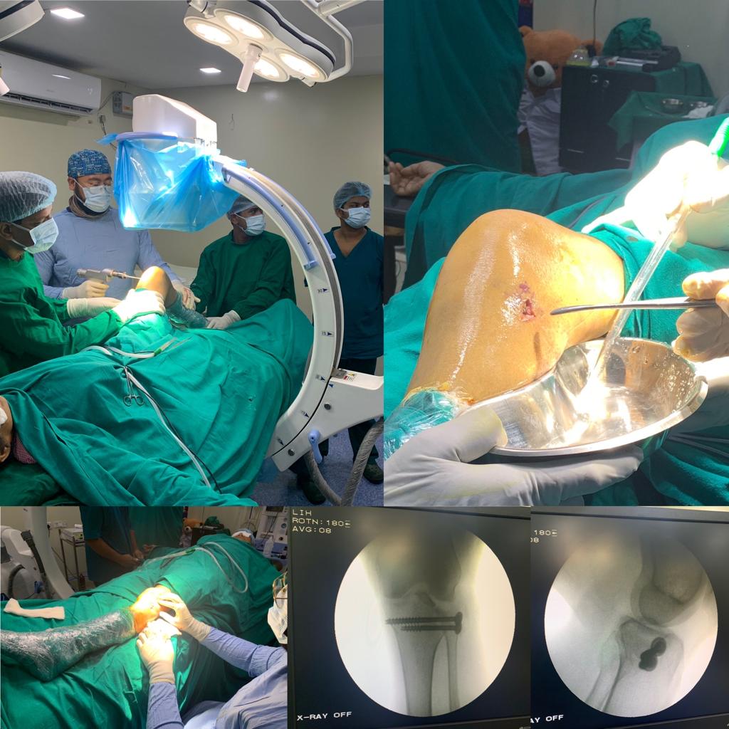 Minimally Invasive Osteosynthesis with an incision of merely 1.7 cm