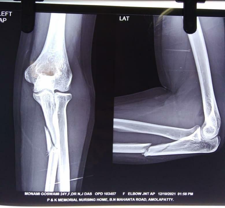Left-sided Monteggia Fracture