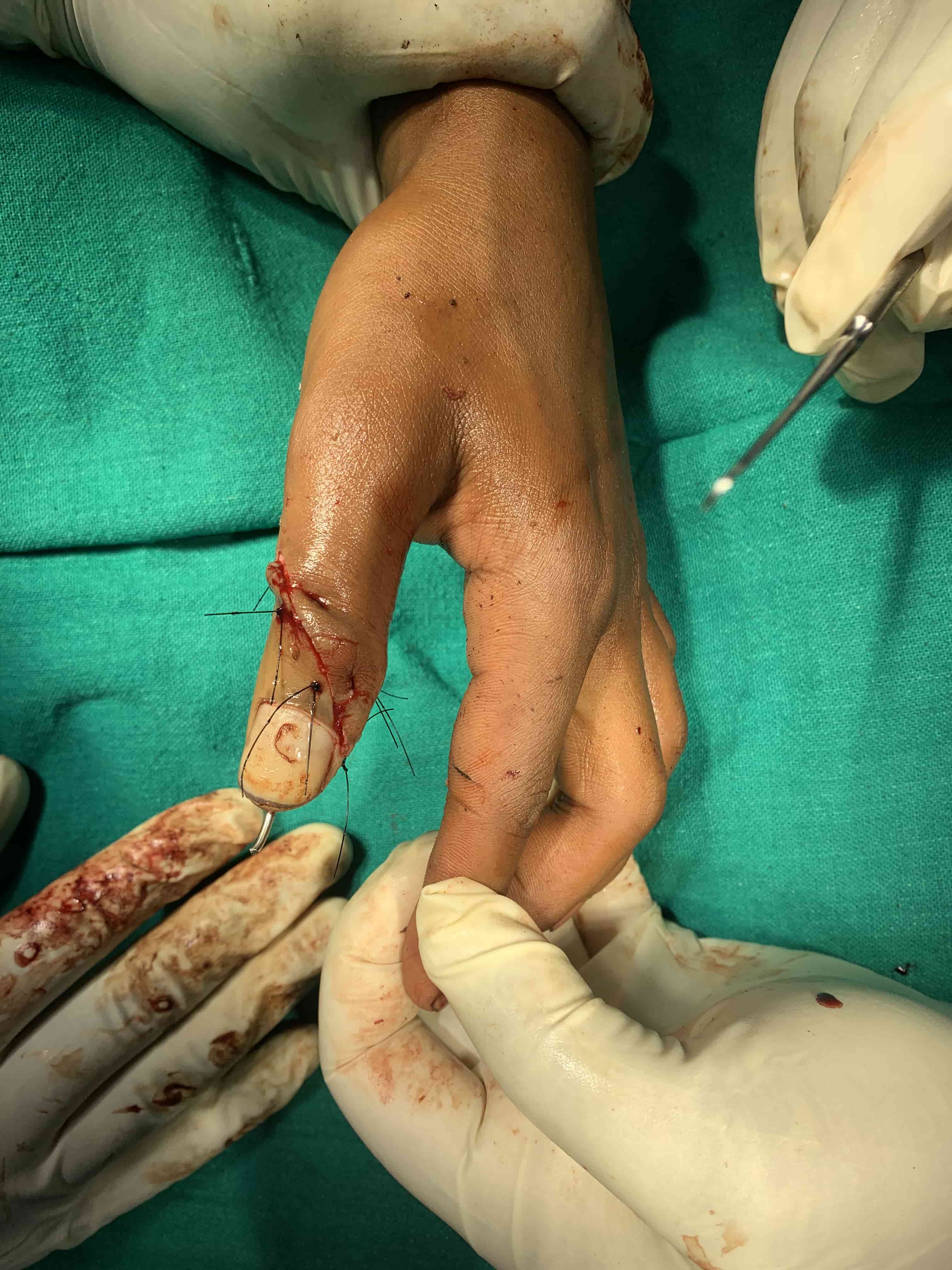 Complex Distal Humerus Comminuted Fracture