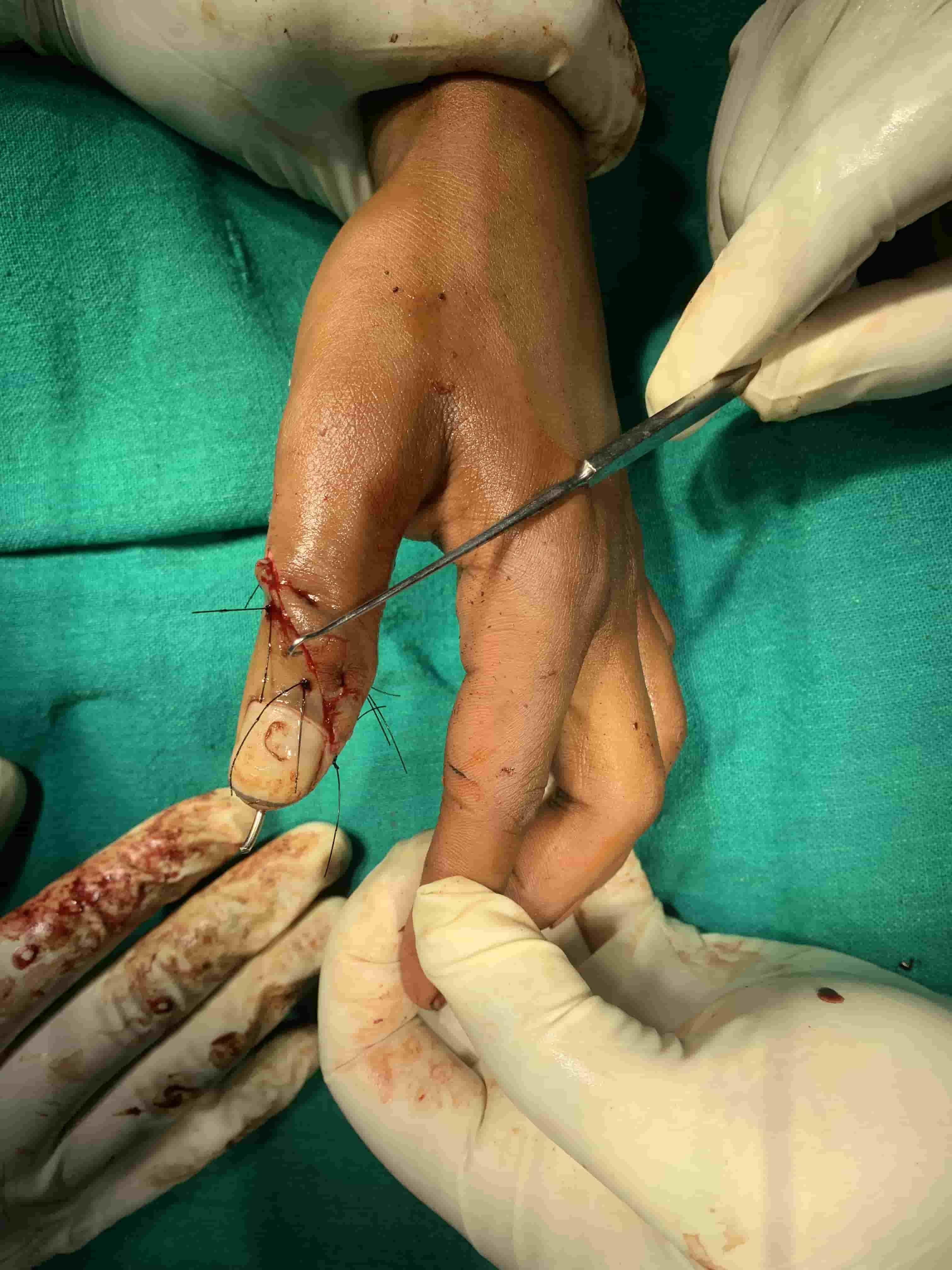 Ankle Sprain With Pott’s Fracture