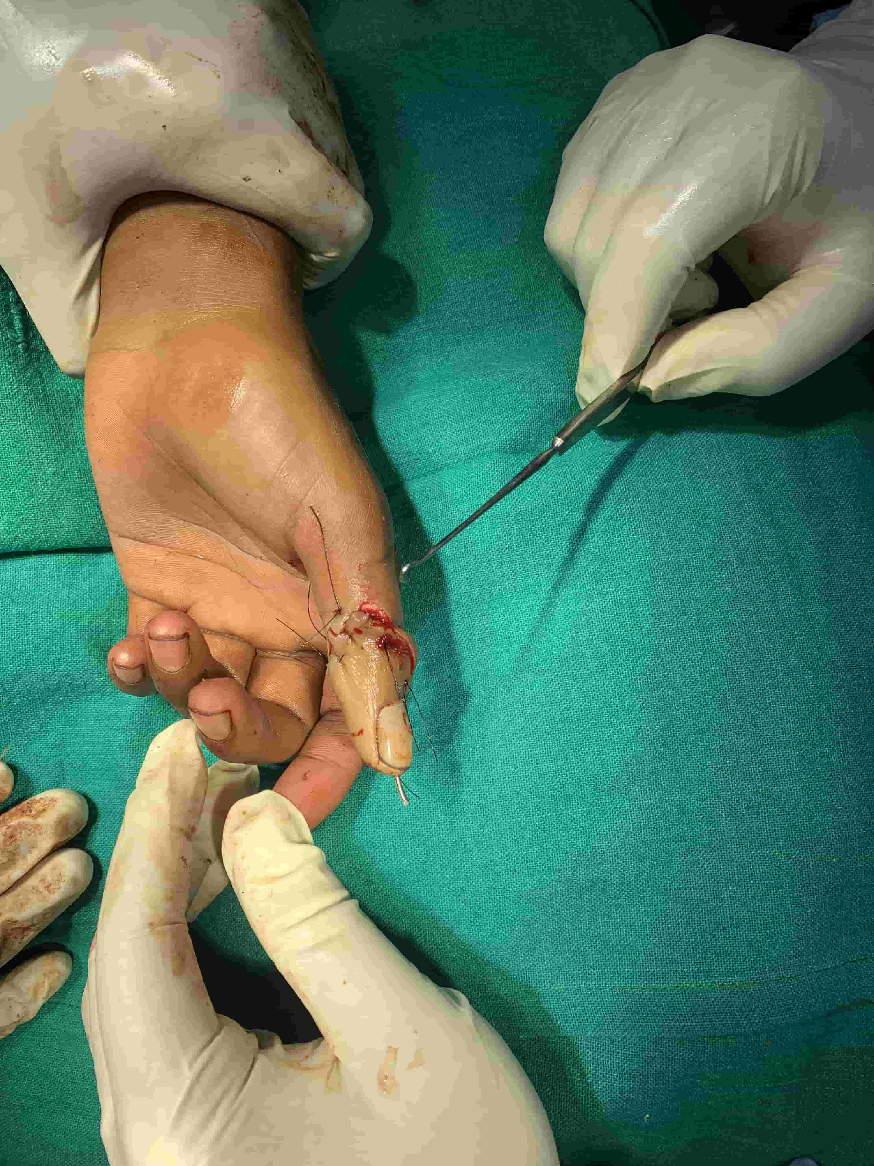 Ankle Sprain With Pott’s Fracture