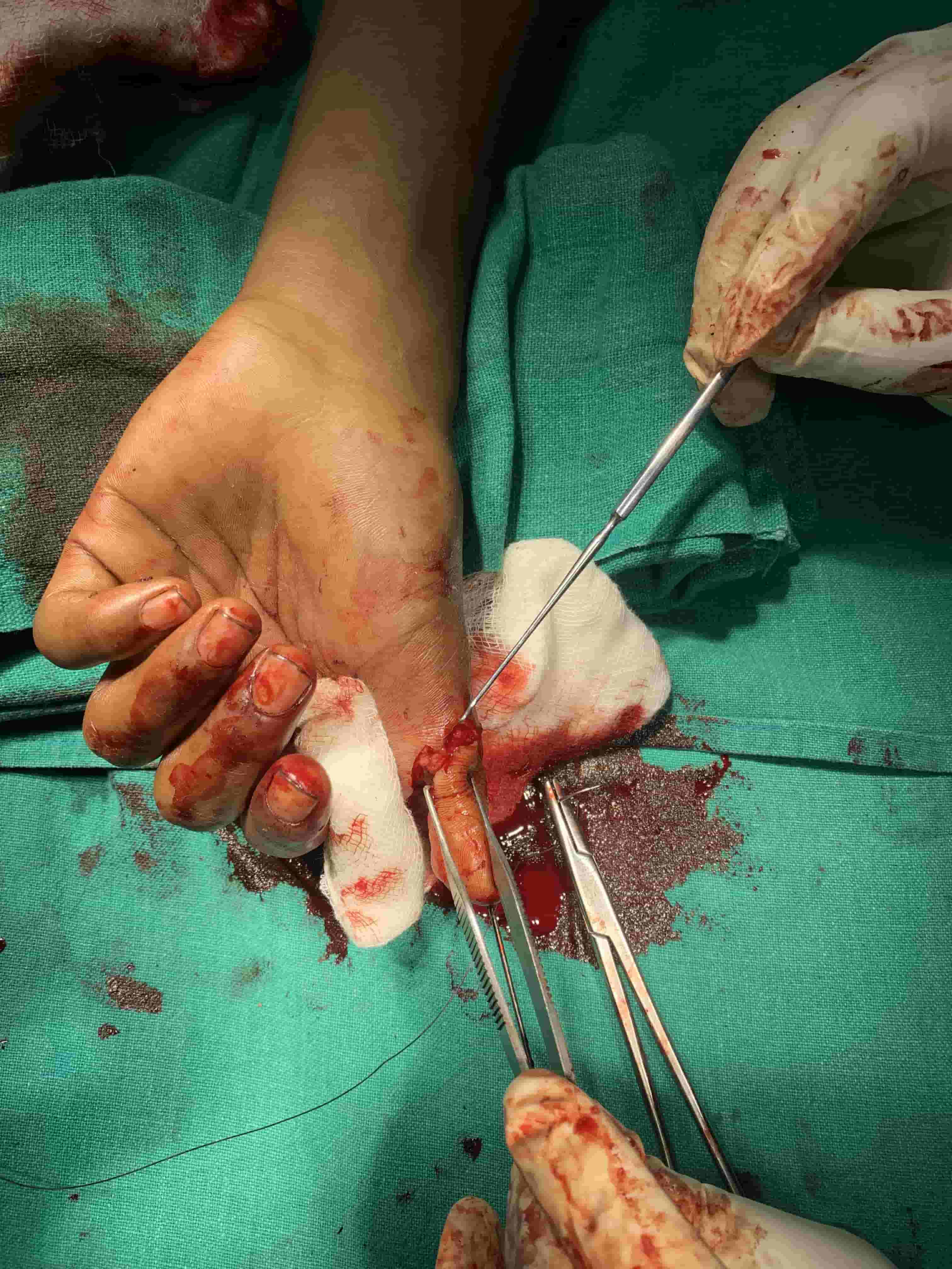 Ankle Sprain With Pott’s Fracture