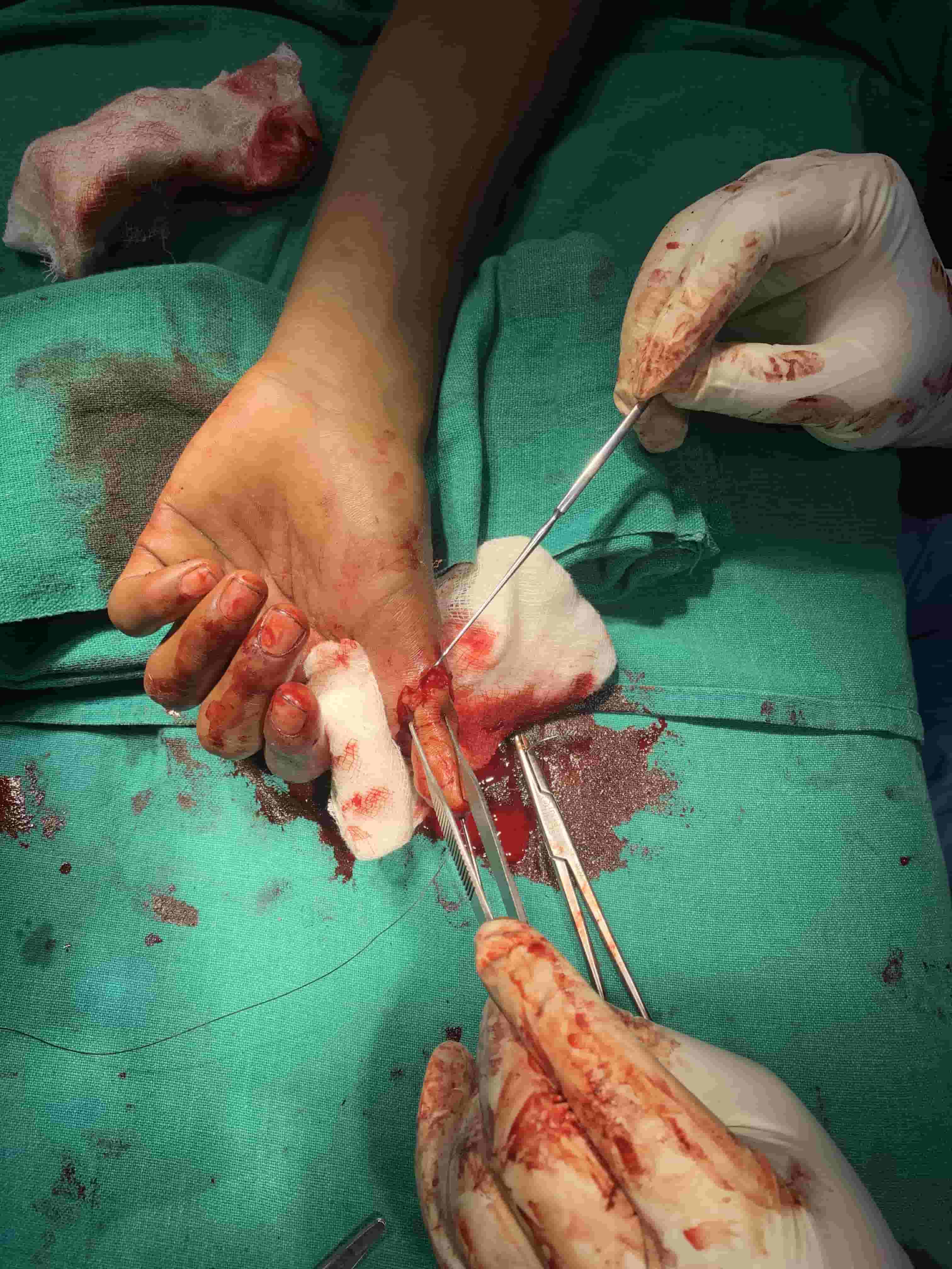 Ankle Sprain With Pott’s Fracture