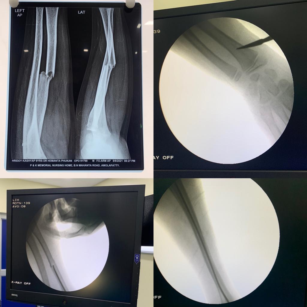 Titanium Elastic Nailing With 3 Point Fixation Done For A School Going Kid Sustaining A Radial Shaft Fracture With Complete Displacement & Volar Apex Angulation Deformity
