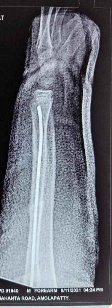 Titanium Elastic Nailing With 3 Point Fixation Done For A School Going Kid Sustaining A Radial Shaft Fracture With Complete Displacement & Volar Apex Angulation Deformity