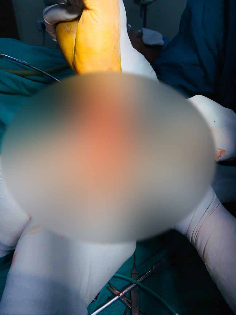 Wide Excision In Toto of a Fibroma