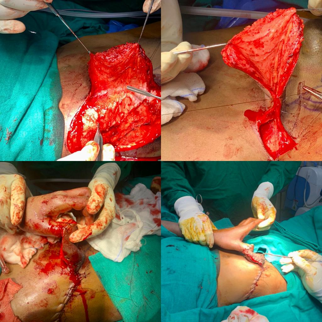 Soft Tissue Reconstruction By Abdominal Groin Pedicled Flap